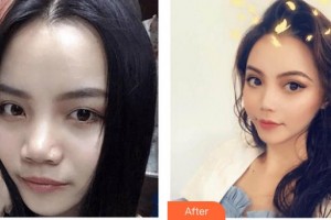 上海保加醫(yī)療美容門診部楊勇整形價格表附硅膠鼻部手術案例展示