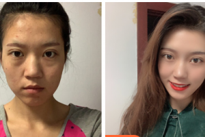 南京韓辰整形醫(yī)院李炯柱整形價(jià)格表附肋軟骨隆鼻案例展示