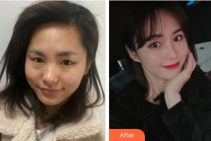 上海俞世放醫(yī)療美容外科診所俞世放整形價格表附眼部綜合案例展示