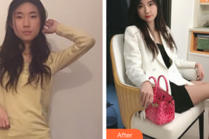 廣州遠(yuǎn)東美容醫(yī)院洪冰瑩主診醫(yī)師整形價(jià)格表附玻尿酸導(dǎo)入精華案例展示