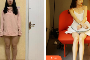 廣州華美醫(yī)療美容醫(yī)院李鐘七整形價(jià)格表附吸脂瘦大腿案例展示