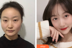 廣州壹加壹美容醫(yī)院鄧艷雯整形價(jià)格表附下頜角磨骨案例展示