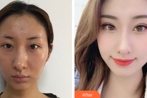 廣州中家醫(yī)家庭醫(yī)生醫(yī)學(xué)整形美容醫(yī)院劉永博整形價(jià)格表附顴骨內(nèi)推案例展示