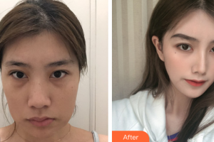 廣州軍美整形醫(yī)院趙希純整形價(jià)格表附面部輪廓案例展示