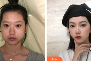 廣州博仕整形美容醫(yī)院韓東均整形價(jià)格表附下頜骨磨角案例展示