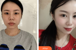 廣州中科美整形醫(yī)院張金明整形價(jià)格表附眼部綜合案例展示