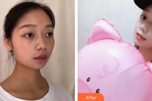 廣州康華清醫(yī)學(xué)美容門診部潘立清整形價(jià)格表附水氧活膚案例展示