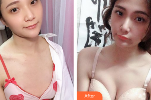 廣州利美康粵美醫(yī)療美容門診部范建輝整形價格表附自體脂肪隆胸案例展示