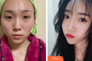 廣州中家醫(yī)家庭醫(yī)生醫(yī)學整形美容醫(yī)院龍曉枚整形價格表附顴骨內(nèi)推案例展示