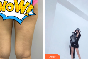 廣州海峽醫(yī)學整形美容醫(yī)院郭棟整形價格表附大腿吸脂案例展示