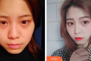 廣州醫(yī)學院第三附屬醫(yī)院整形科廖農(nóng)整形價格表附	激光美膚激光案例展示