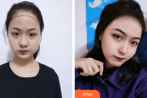 廣州韓妃醫(yī)學美容醫(yī)院萬麗整形價格表附發(fā)際線種植案例展示