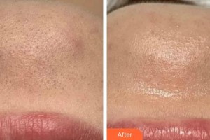 上海宏康醫(yī)院整形美容中心馮志毅整形價格表附白瓷案例展示