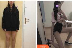 上海東方麗人美容醫(yī)療醫(yī)院劉洋整形價(jià)格表附大腿吸脂案例展示