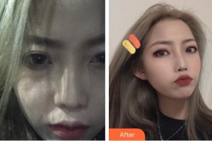 上海仁愛醫(yī)院整形美容科朱啟剛整形價(jià)格表附毛發(fā)種植案例展示