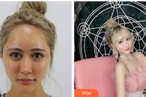 上海仁愛醫(yī)院整形美容科張少博整形價(jià)格表附酒窩案例展示