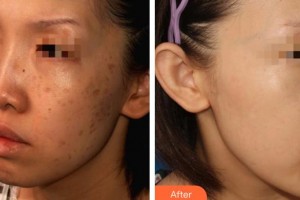 上海伊美爾港華醫(yī)療美容醫(yī)院杜志蘋整形價(jià)格表附激光調(diào)節(jié)曬斑案例展示