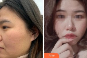 民航上海醫(yī)院整形外科段曉光整形價(jià)格表附下頜角磨骨案例展示