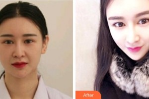 上海米瑞可醫(yī)療美容門診部李喆遠(yuǎn)整形價(jià)格表附面部輪廓案例展示
