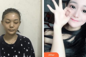 上海瑞陽整形外科門診部孫永剛整形價(jià)格表附種植發(fā)際線案例展示