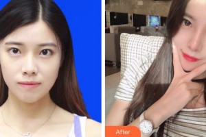 上海諾詩雅醫(yī)療美容醫(yī)院陳達(dá)整形價(jià)格表附肋軟骨隆鼻案例展示