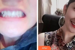 上海港華醫(yī)療美容醫(yī)院忻勤芳整形價格表附牙齒正畸案例展示