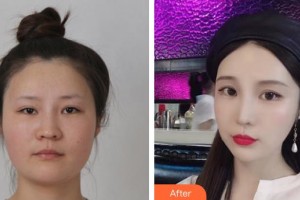 上海仁濟醫(yī)院整形外科祝家學(xué)整形價格表附面部整形案例展示