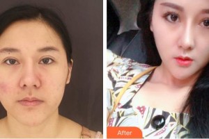 上海仁濟醫(yī)院整形外科徐海淞整形價格表附面部吸脂案例展示