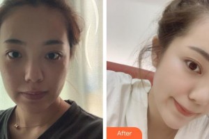 上海仁濟醫(yī)院整形外科顧偉整形價格表附頜面整形案例展示