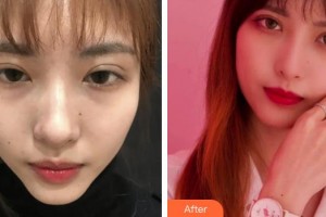 上海美之源整形外科醫(yī)院崔爽整形價格表附超激光美膚嫩膚多方面部案例展示