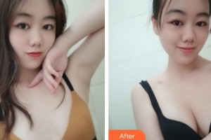 上海玫瑰醫(yī)療美容醫(yī)院郭世偉整形價格表附濃縮豐胸案例展示