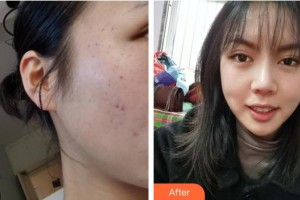 上海富華醫(yī)療美容醫(yī)院李梅整形價格表附面部祛斑案例展示