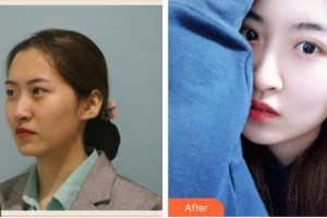 上海仁愛醫(yī)院整形美容科戴君來整形價格表附光子套餐案例展示