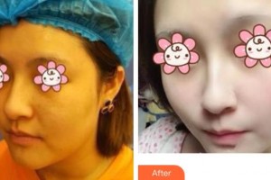 上海仁愛醫(yī)院整形美容科李曉慶整形價格表附嫩白肌膚祛斑案例展示