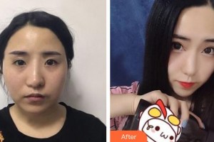 上海復(fù)旦大學(xué)附屬中山醫(yī)院整形外科楊震整形價格表附前茅面部吸脂案例案例展示