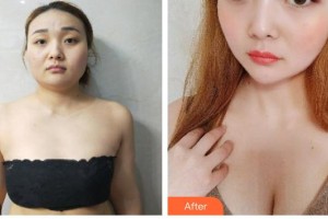 上海百達(dá)麗醫(yī)療美容醫(yī)院周珍艷整形價格表附豐胸案例展示