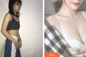 上海博愛醫(yī)院整形科高健整形價格表附假體隆胸案例展示