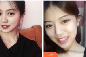 上海申德醫(yī)院醫(yī)療美容科李真圭整形價格表附面部吸脂案例展示