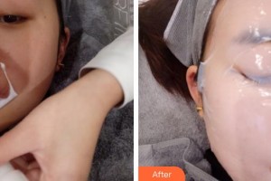 上海市皮膚病醫(yī)院醫(yī)療美容科石鈺整形價格表附光子嫩膚案例展示