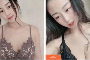 上海光博士醫(yī)療美容門診部阮雅君整形價格表附自體脂肪隆胸案例展示