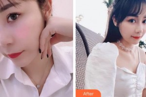 上海伊萊美醫(yī)療美容醫(yī)院劉海松整形價格表附合金烤瓷牙案例展示