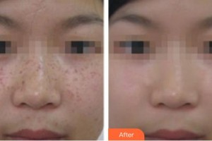 上海伊萊美醫(yī)療美容醫(yī)院莫雅晴整形價格表附祛斑案例展示