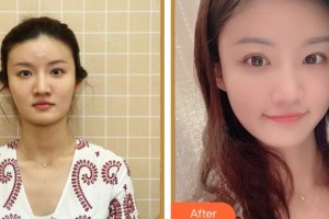 上海伊萊美醫(yī)療美容醫(yī)院何生靜整形價格表附曬后修復(fù)案例展示