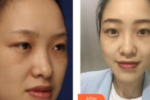 上海復(fù)麗醫(yī)療美容門診部林繡諭整形價格表附激光祛斑案例展示