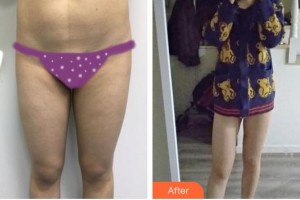 上海申德醫(yī)院醫(yī)療美容科劉啟整形價格表附腰腹加大腿吸脂案例展示