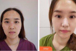 上海市皮膚病醫(yī)院醫(yī)療美容科章偉整形價格表附激光祛痣點痣案例展示