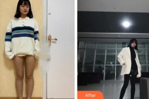 上海復(fù)麗醫(yī)療美容門診部張家偉整形價格表附吸脂瘦大腿案例展示
