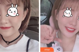 上海市皮膚病醫(yī)院醫(yī)療美容科王娜整形價格表附光子嫩膚案例展示