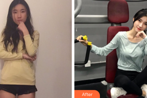 廣州番禺陽光整形美容醫(yī)院陳瑞雄整形價格表附玻尿酸導入案例展示