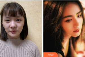 廣州市荔灣區(qū)人民醫(yī)院整形美容中心杜毅整形價格表附肋軟骨隆鼻案例展示